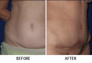 Galerija Pre i Posle: Abdominoplastika Abdominoplasty