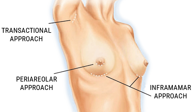 Breast Augmentation Breast Augmentation