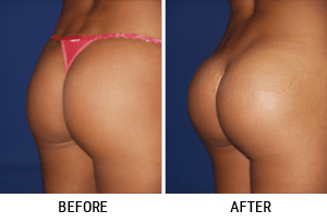 Buttock Augmentation