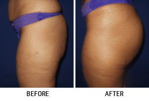 Liposuction