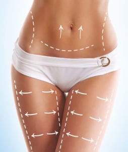 liposuction liposuction
