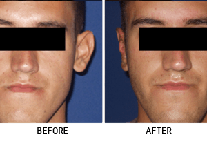 Galerija Pre i Posle - Korekcija ušiju Ear Reshaping