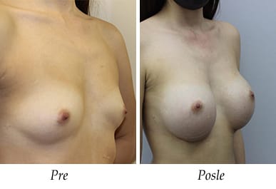 Breast Augmentation - Patient 03
