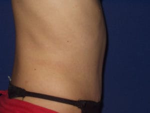 Abdominoplastika - Pacijent 1