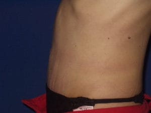 Abdominoplastika - Pacijent 1