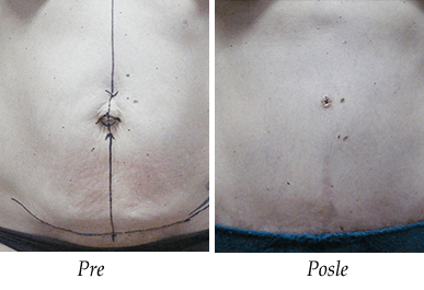 Abdominoplastika - pacijent 4