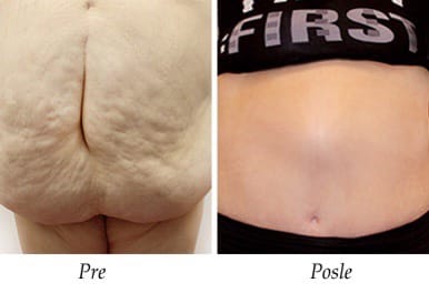 Abdominoplastika - pacijent 6