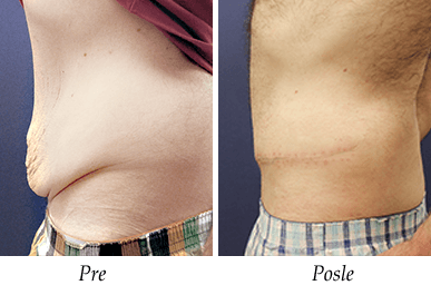 Abdominoplastika - pacijent 5