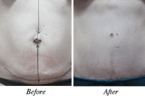 Abdominoplasty - patient 4