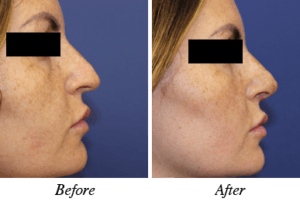 nose correction - patient 4