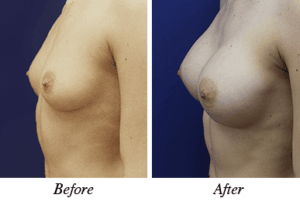 Breast augmentation - patient 13