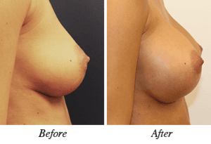 Breast augmentation - patient 16