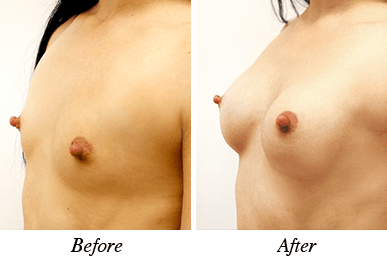 Breast augmentation - Patient 19
