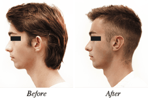 Ear reshaping before and after - patient 2