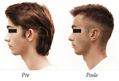 Korekcija usiju pre i posle pacijent 2