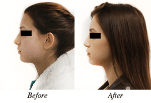 Nose correction - Patient 17