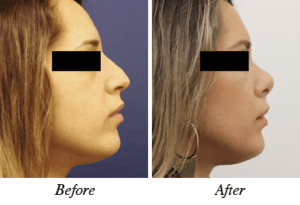 Nose correction - before after patient 7