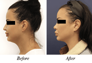 Nose correction - patient 12