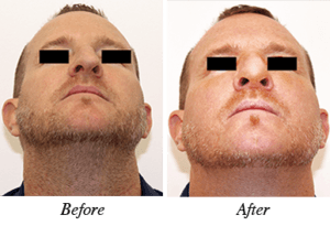 Nose correction - patient 18