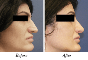 Nose correction - patient 9