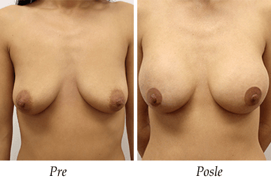 Pacijent 14 - pre i nakon uvećanja grudi