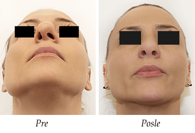 Pacijent 19 - Pre i posle korekcije nosa