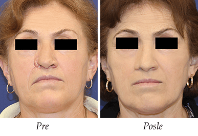 Pacijent 20 - Pre i posle korekcije nosa