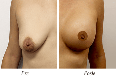 Pacijent 24 - pre i nakon intervencije