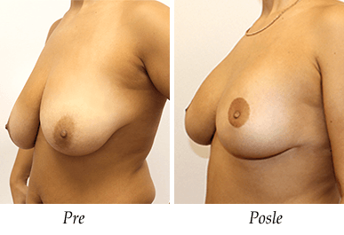 Pacijent 25 - pre i nakon podizanja i uvećanja grudi
