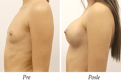 Pacijent 26 - pre i nakon uvećanja grudi