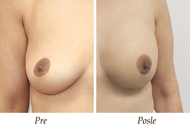 Pacijent 31 - Pre i nakon uvećanja grudi