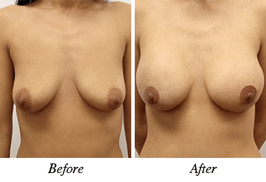 Patient 14 - before and after breast augmentation