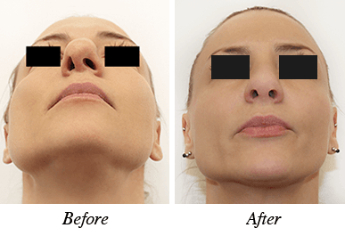 Nose correction - patient 19