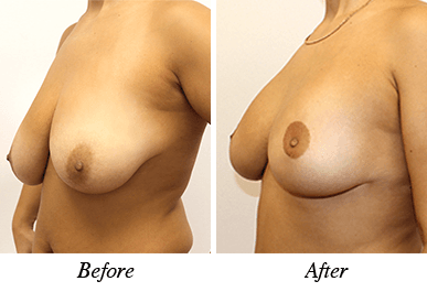 Patient 25 - before and after breast lift and augmentation