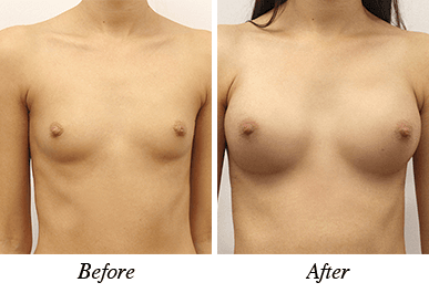 Patient 26 - Before and after breast augmentation