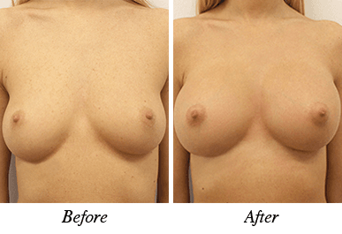 Patient 27 - Before and after breast augmentation
