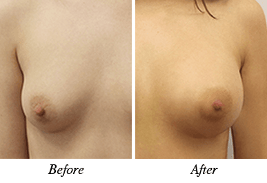 Patient 28 - Before and after breast augmentation