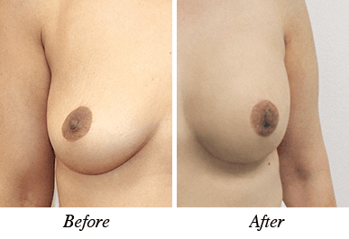 Patient 31 - Before and after breast augmentation
