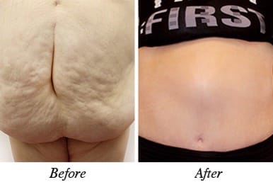 Patient 6 - Abdominoplasty