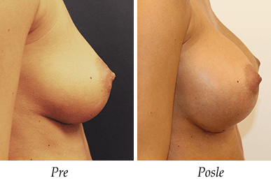 Uvećanje grudi - pacijent 16