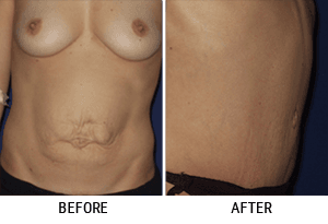 tummytuck