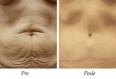 abdominoplastika - pacijent 3