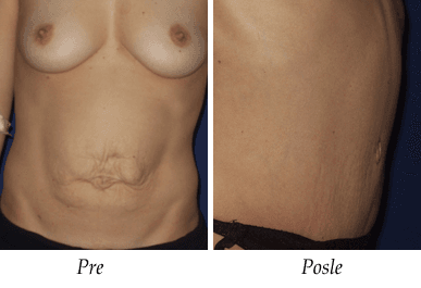 Abdominoplastika