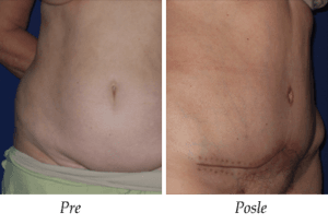 Galerija Pre i Posle: Abdominoplastika Galerija Pre i Posle: Abdominoplastika