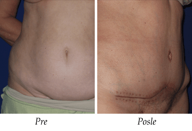Abdominoplastika