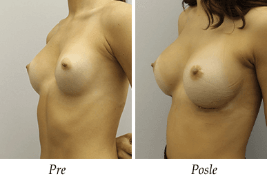 Breast Augmentation - Patient 03