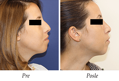 korekcija nosa - pre i posle