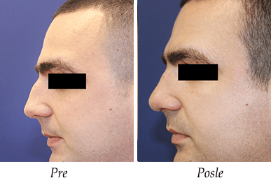 korekcija nosa -pre-posle