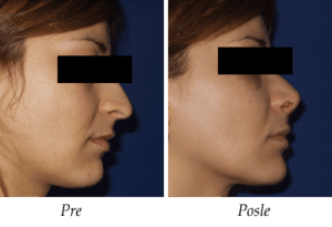 Galerija Pre i Posle - Korekcija nosa Korekcija nosa