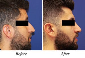 nose correction - patinet 5